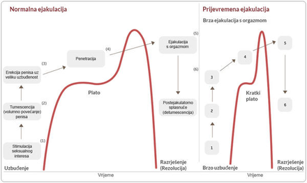 Grafikon 1: Ciklus seksualnog odgovora muškarca kod normalnog muškarca i kod muškarca koji pati od PE-a.